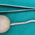 Роди се бебе с 12-сантиметрова „човешка опашка“ в Бразилия