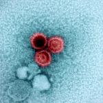 Свързаха лупуса с вирус, който над 95 процента от нас носят – и вече знаем защо