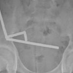 Тийнейджър загуби част от червата си, след като погълна близо 200 магнита