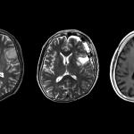Пациентите с рядък вид астроцитом - тумор на неврона - имат по-лоша прогноза от очакваното