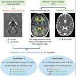 Шизофренията е свързана с дефицит на желязо и миелин в мозъка