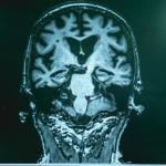 Можем ли да диагностицираме деменция чрез изкуствен интелект?