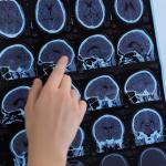 Създадоха тест за ранна диагностика на множествена склероза