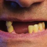 Клиничните изпитвания на терапия за възстановяване на зъби стартират догодина