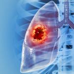 Липсващ раков ген обяснява защо някои тумори на белия дроб реагират добре на имунотерапия