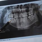 21-годишно проучване свързва пародонтозата и кариесите с повишен риск от инсулт