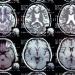 Започна търсене на нови маркери за откриване на мозъчните разстройства и тяхното лечение