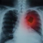 Ракът на белия дроб е сред петте най-често срещани видове рак