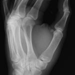 Рентгеновите лъчи са открити съвсем случайно