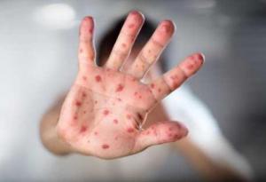 Варицела плъзна в цялата страна