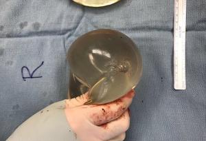 Гръден имплант спаси живота на жена, като промени траекторията на куршум