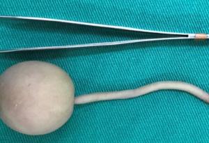 Роди се бебе с 12-сантиметрова „човешка опашка“ в Бразилия