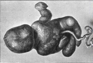 При това рядко явление плодът в утробата на майката се вкаменява