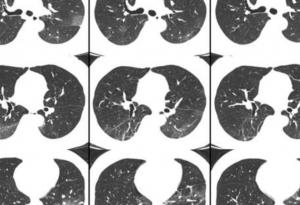 Ето какво се случва с белите дробове на хора с COVID-19