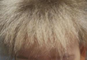 Момче е сред 100-те души в света, страдащи от „синдрома на непокорната коса“