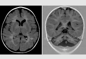 Изследователи разгадаха медицинската загадка на неврологични симптоми при деца
