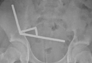 Тийнейджър загуби част от червата си, след като погълна близо 200 магнита