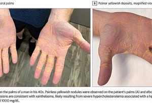 Мъж на месоядна диета (карнивор) получава жълтеникави възли по ръцете, краката и лактите си