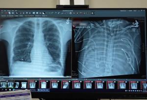 Пациент оцеля 48 часа без бели дробове в подготовка за трансплантация