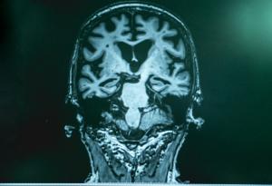 Изкуствен интелект може да диагностицира деменция за един ден – години преди първите симптоми