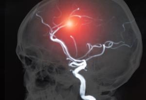 Учени създадоха „жива“ аневризма от кръв и човешки мозъчни клетки