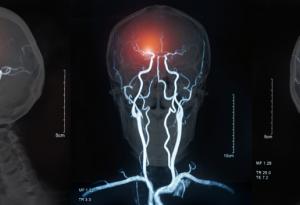 Ето какво се случва по време на инсулт