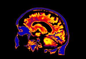Изследване установи поразителни промени в нивата на металите в мозъка на болни от Хънтингтън 