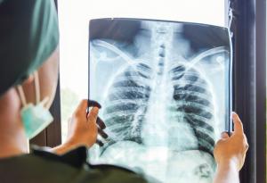 Случаите на туберкулоза са се увеличили за първи път от години