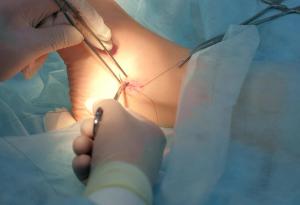 Този лекар извършва три сериозни операции върху себе си