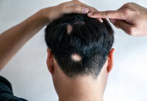 Какво представлява алопецията и има ли лек срещу нея?