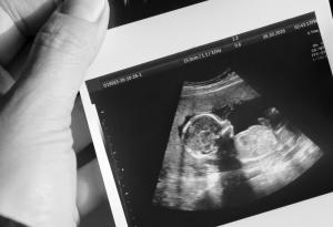 Шанс 1 на 50 милиона: Жена с двойна матка забременя и във всяка има по едно бебенце