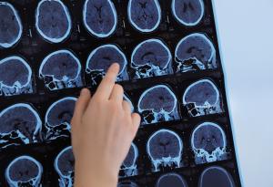 Създадоха тест за ранна диагностика на множествена склероза