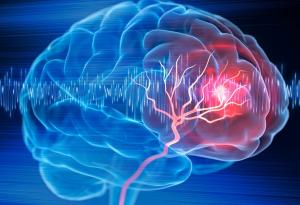 Капки за нос защитават мозъка от някои от последиците от инсулт