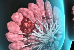 Проучване разкрива защо имунотерапиите не действат при най-трудно лечимите видове рак на гърдата
