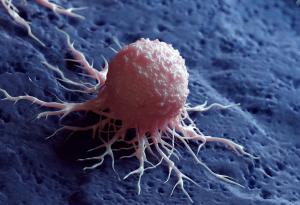 Повечето предотвратими случаи на рак са свързани само с два навика