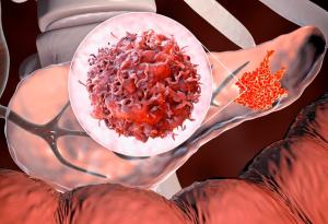 Нов дихателен тест може да промени из основи ранното откриване на рак на панкреаса