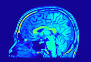 Промените във формата на мозъка могат да бъдат свързани с риск от деменция