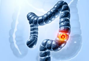 Новооткрит вирус в чревните бактерии е свързан с колоректалния рак