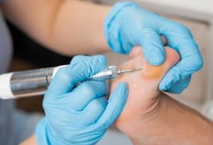 Мазолите - кога вече не са безопасни?