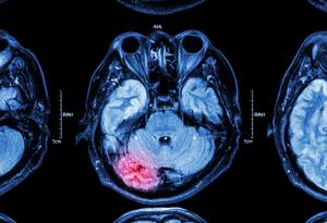 Мозъкът може би е в състояние да се възстановява сам. С малко помощ