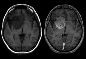 За този смъртоносен рак на мозъка няма лек. Учени обаче откриха как да го преборят