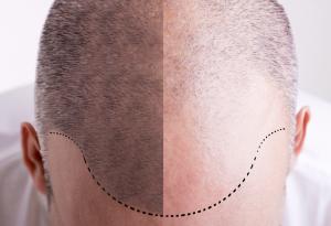 Пластир с разтворими микроигли бори първопричините за косопада