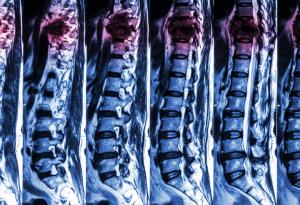 Потенциално антираково лекарство поправя и увредени нерви при травми на гръбначния стълб