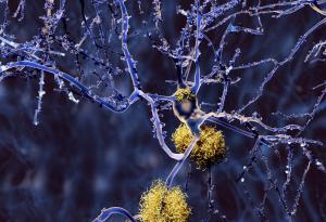 В битка с Алцхаймер – ново лекарство забавя развитието на болестта