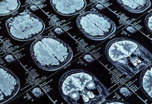 Хормонална терапия би могла да повиши когнитивната функция при хора със синдрома на Даун