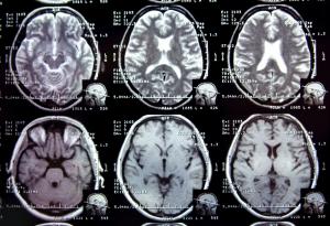 Започна търсене на нови маркери за откриване на мозъчните разстройства и тяхното лечение