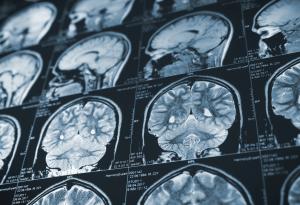 Франция спря проучванията на прионовите болести, след като втори лаборант хвана смъртоносно мозъчно заболяване