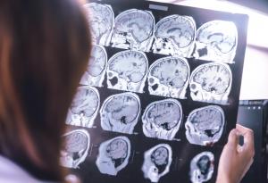 Нови данни свързват загубата на зрение с деменцията