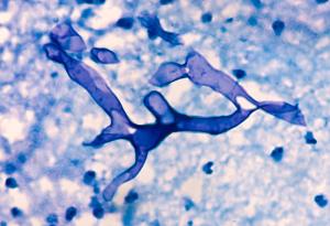 Терапия с антитела: Нов пробив в лечението на смъртоносната мукормикоза