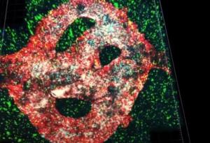 За първи път 3D принтираха смъртоносен тумор на мозъка в лаборатория